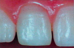 Bleaching - natürliche Zahnfarbe