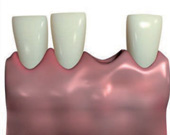 Minimalinvasive Methode der Implantologie - Bild 1