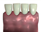 Minimalinvasive Methode der Implantologie - Bild 6