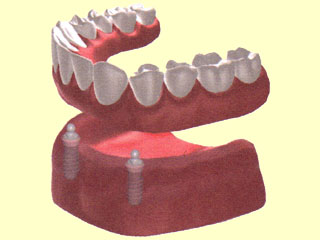 Insertion of 2 ball anchors into an existing mandibular prosthesis