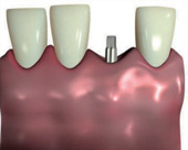 Minimalinvasive Methode der Implantologie - Bild 3