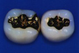 Gold-Inlay