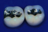 Amalgam