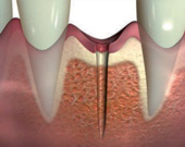 Minimalinvasive Methode der Implantologie - Bild 2