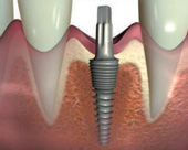 Minimalinvasive Methode der Implantologie - Bild 5