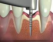 Minimalinvasive Methode der Implantologie - Bild 4