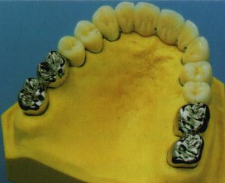 Fixed ceramic bridge