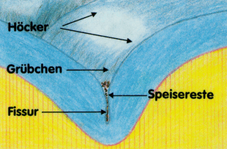 This is how the first caries develops