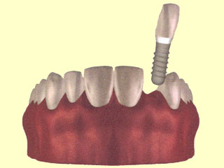 Implant with crown