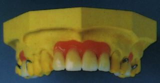 Removable model casting prosthesis
